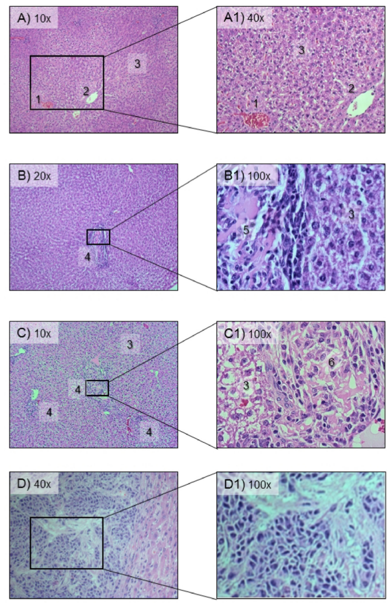 Genes & Cancer | Pancreatic carcinoma cells colonizing the liver modulate  the expression of their extracellular matrix genes