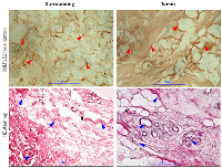 Figure 2: Immunohistochemistry- SULT1E1 expression in tumor tissue and adjacent surrounding tissue. 